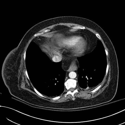 Breast carcinoma with pathological hip fracture (Radiopaedia 60314-67974 A 41).jpg