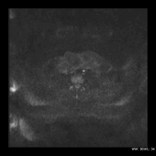 File:Broad ligament fibroid (Radiopaedia 49135-54241 Axial DWI 4).jpg