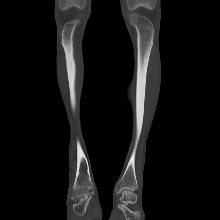 Brodie abscess - tibia (Radiopaedia 66028-75204 Coronal bone window 6).jpg