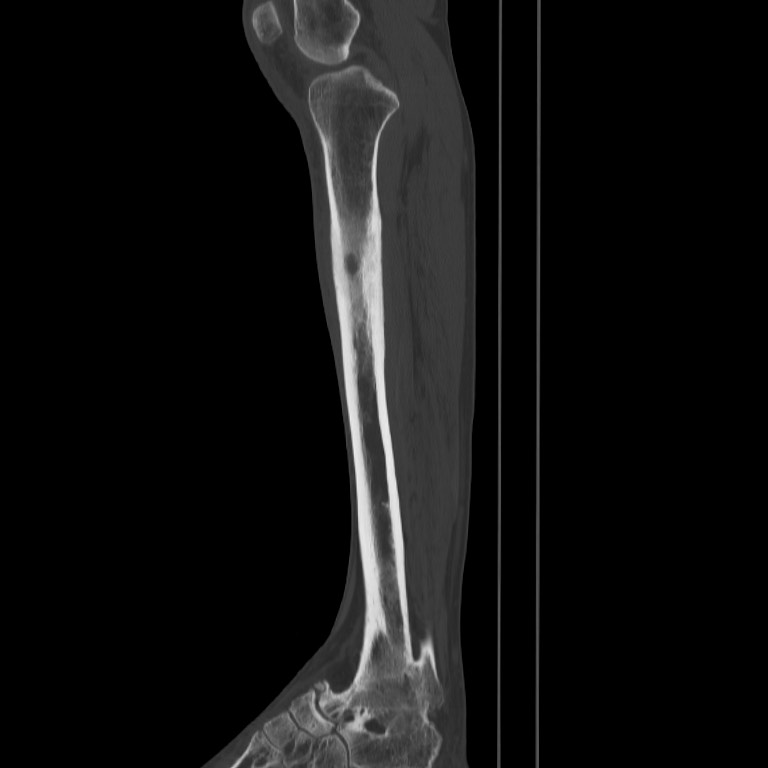 Brodie abscess - tibia (Radiopaedia 66028-75204 Sagittal bone window 31).jpg