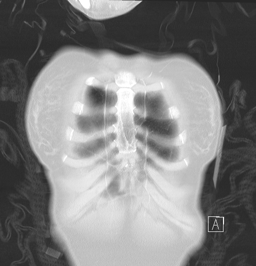 File:Bronchial atresia (Radiopaedia 73677-84470 Coronal lung window 3).jpg