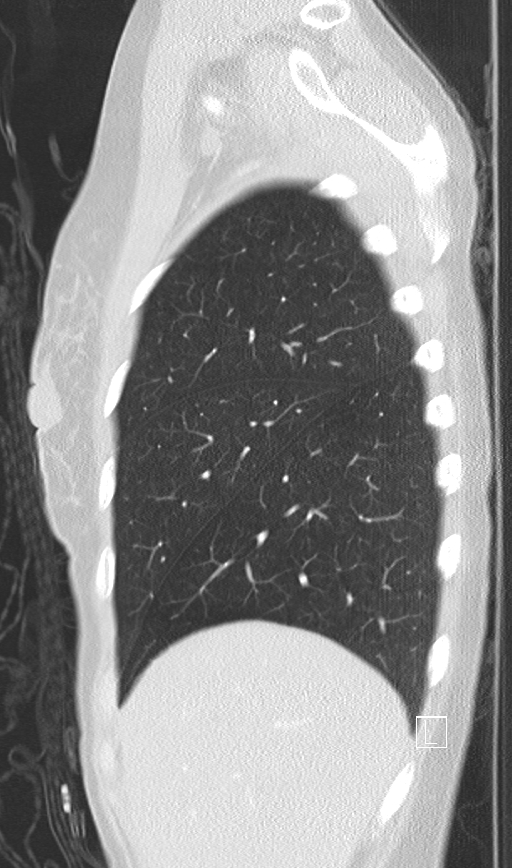 Bronchial atresia (Radiopaedia 73677-84470 Sagittal lung window 9).jpg