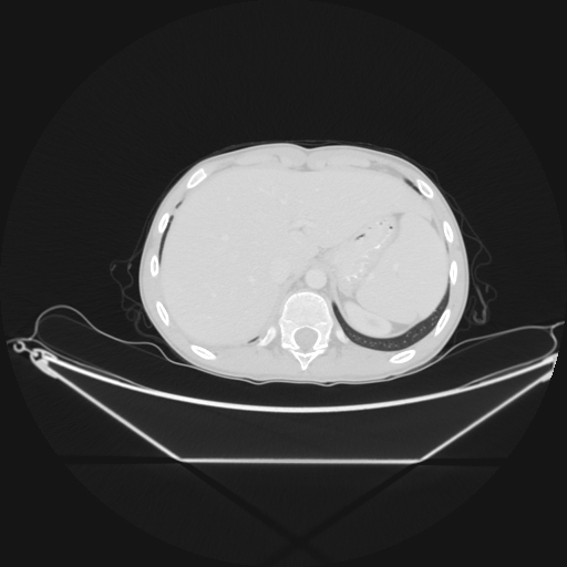 Bronchial carcinoid tumor (Radiopaedia 57187-64090 Axial lung window 72).jpg