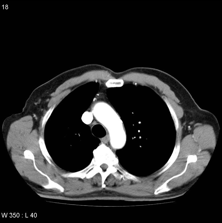 Bronchial carcinoid tumor with right lower lobe collapse (Radiopaedia 29060-29422 A 17).jpg