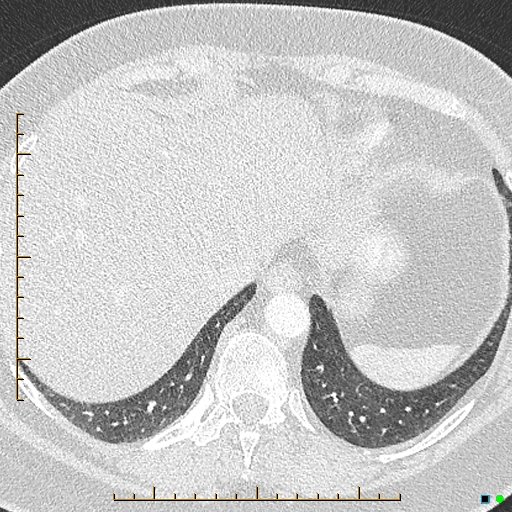 File:Bronchial diverticula (Radiopaedia 79512-92676 Axial lung window 178).jpg
