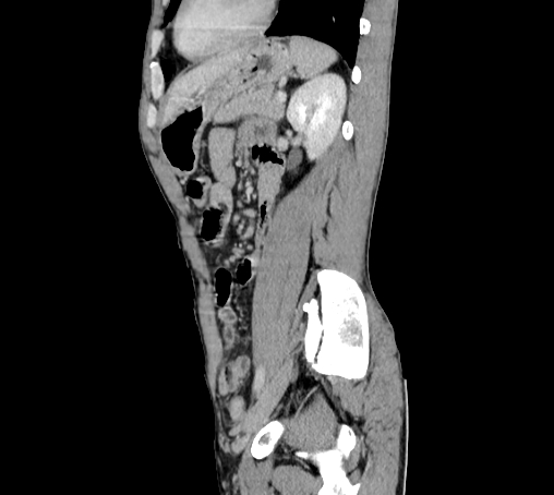 File:Bronchiectasis in Crohn disease (Radiopaedia 60311-67977 D 79).jpg