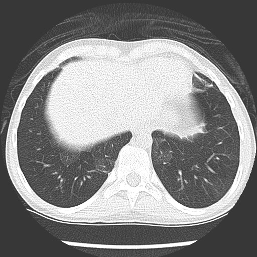 Bronchiolotis obliterans (Radiopaedia 73769-84575 Axial lung window 39).jpg