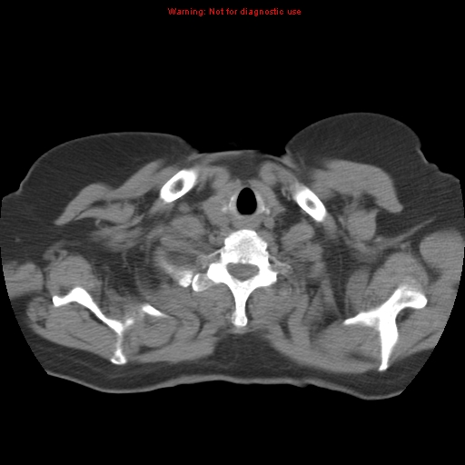 Bronchoalveolar carcinoma (Radiopaedia 13224-13233 Axial non-contrast 3).jpg