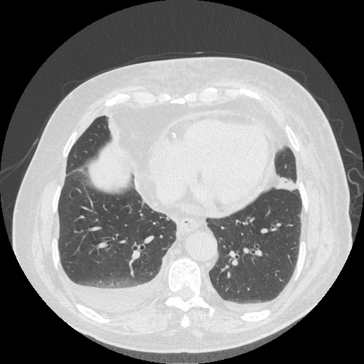 Bronchogenic carcinoma with metastatic lymphadenopathy (Radiopaedia 37671-39569 Axial lung window 40).jpg