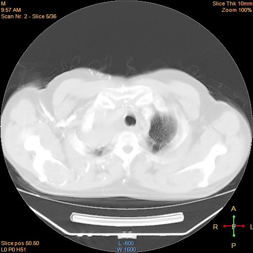 File:Bronchogenic carcinoma with superior vena caval invasion (Radiopaedia 22378-22406 lung window 2).jpg