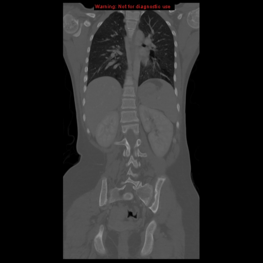 File:Brown tumor (Radiopaedia 12318-12596 D 44).jpg