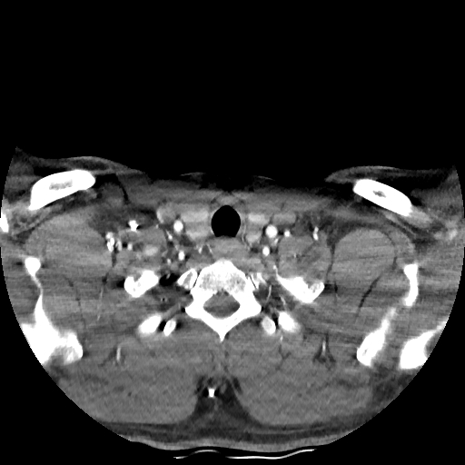 Buccal fat pad arteriovenous malformation (Radiopaedia 70936-81144 D 56).jpg