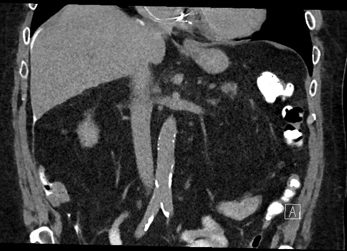 Buried bumper syndrome - gastrostomy tube (Radiopaedia 63843-72577 Coronal Inject 69).jpg