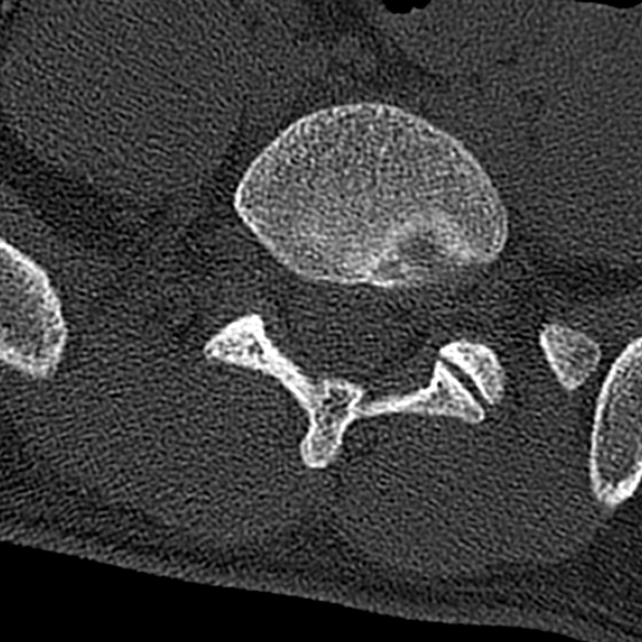 Burst fracture (Radiopaedia 53373-59357 Axial bone window 62).jpg