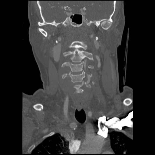 C1 anterior arch (plough) fracture - type 1 (Radiopaedia 76181-87720 Coronal bone window 62).jpg