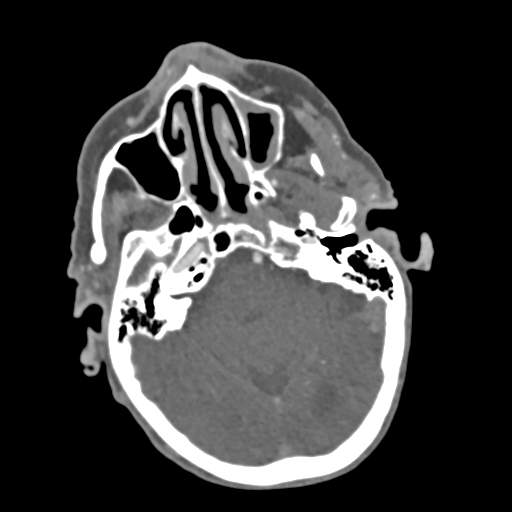 File:C2 fracture with vertebral artery dissection (Radiopaedia 37378-39200 A 212).png