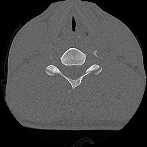 File:C5 facet fracture (Radiopaedia 58374-65499 Axial bone window 56).jpg