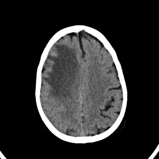 File:CNS Lymphoma (Radiopaedia 44198-47794 Axial non-contrast 26).png
