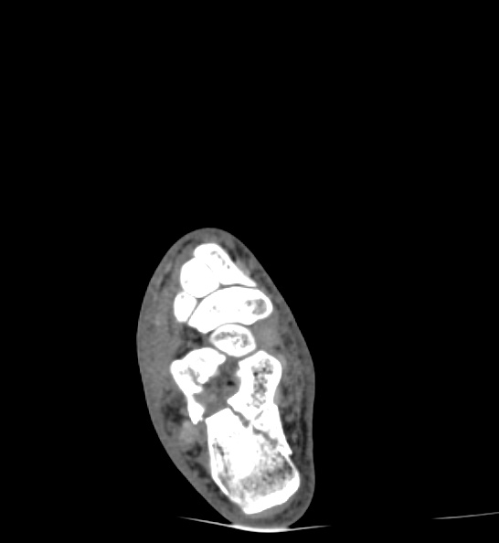 Calcaneal fracture - Sanders type 3ac (Radiopaedia 82491-96862 C 75).jpg