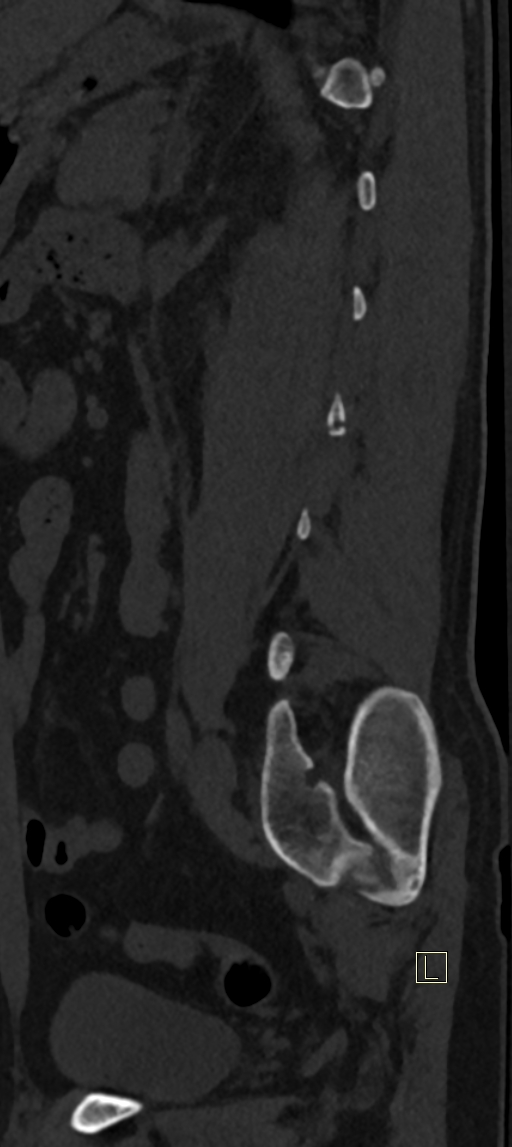 Calcaneal fractures with associated L2 burst fracture (Radiopaedia 71671-82493 Sagittal bone window 13).jpg