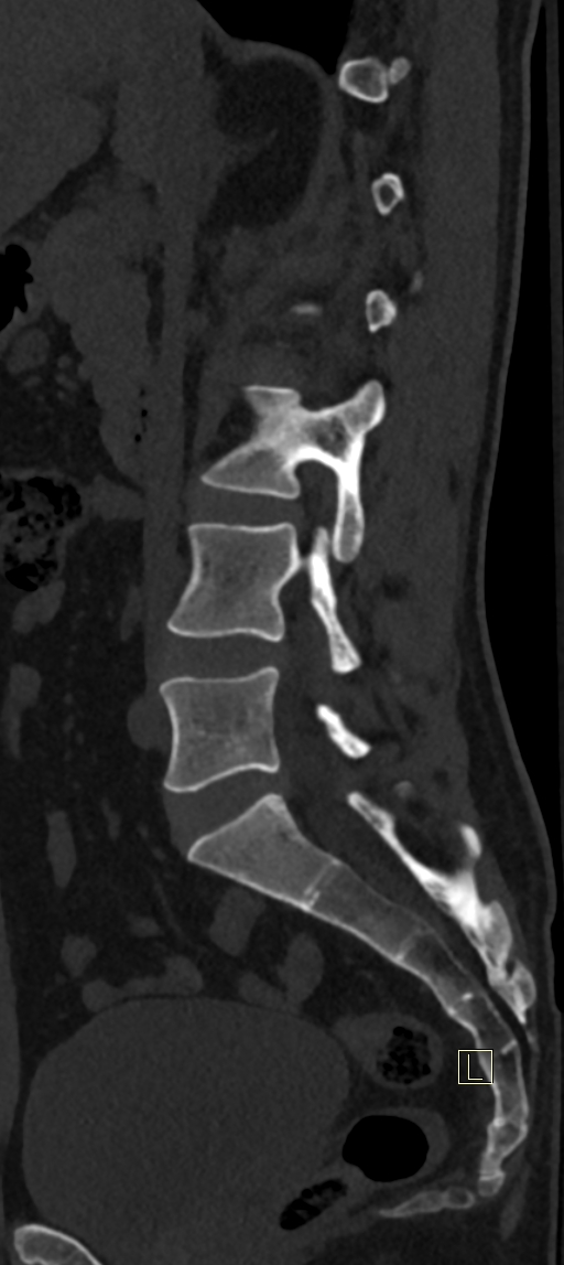 Calcaneal fractures with associated L2 burst fracture (Radiopaedia 71671-82493 Sagittal bone window 49).jpg