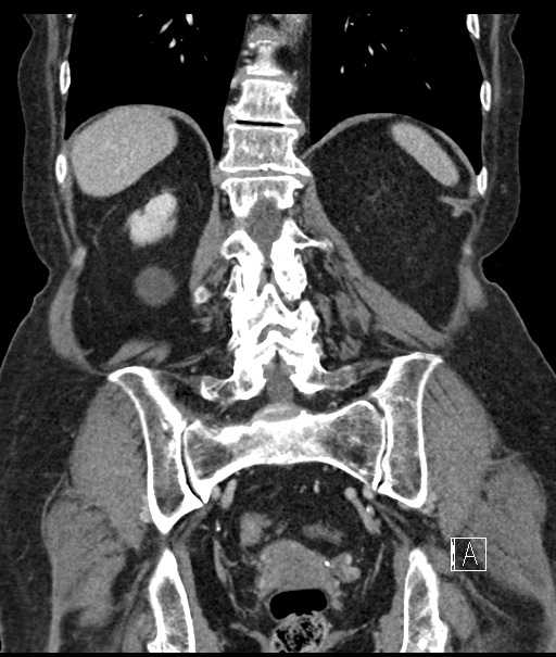 Calcified adrenal glands and Spigelian hernia (Radiopaedia 49741-54988 B 85).jpg