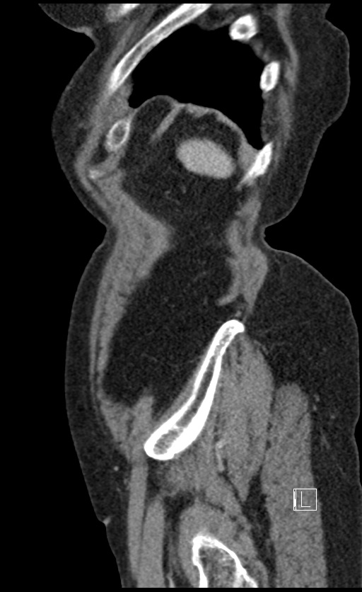 Calcified adrenal glands and Spigelian hernia (Radiopaedia 49741-54988 C 19).jpg