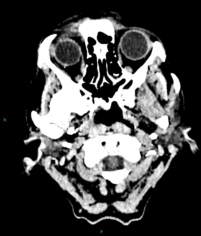 Calcified cerebral emboli from left ventricular thrombus (Radiopaedia 84420-99758 Axial non-contrast 85).jpg