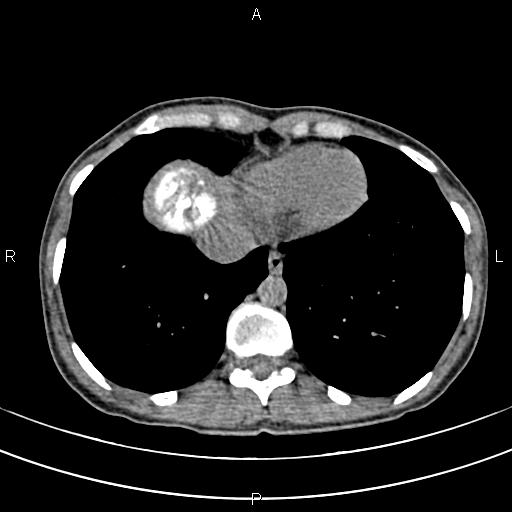 File:Calcified hepatic hydatid cyst (Radiopaedia 83870-99072 Axial non-contrast 10).jpg