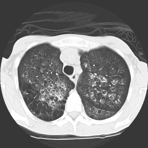 File:Calciphylaxis and metastatic pulmonary calcification (Radiopaedia 10887-11317 Axial lung window 8).jpg