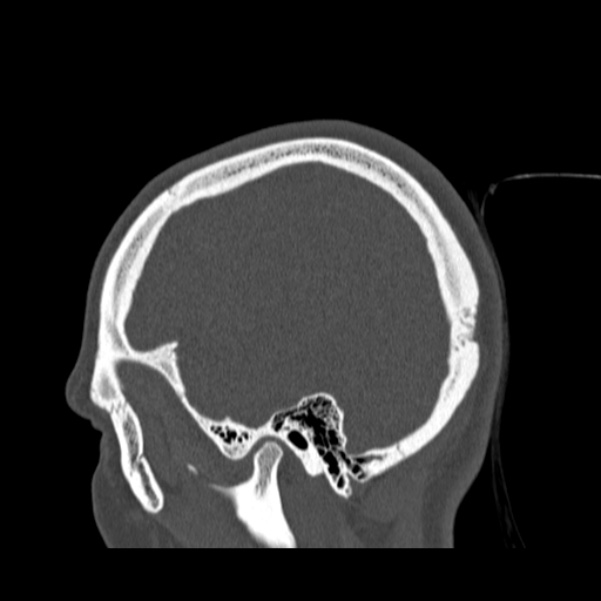 Calvarial osteoma (Radiopaedia 36520-38079 Sagittal bone window 23).jpg