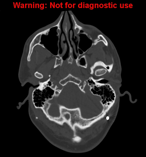 Calvarial thickening from chronic shunting (Radiopaedia 60079-67637 Axial bone window 24).jpg