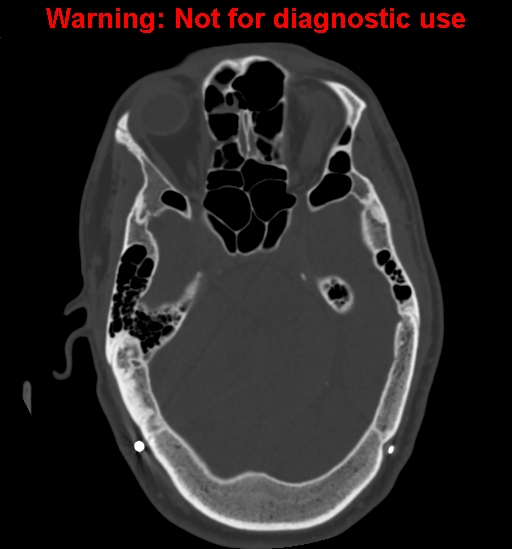 Calvarial thickening from chronic shunting (Radiopaedia 60079-67637 Axial bone window 60).jpg