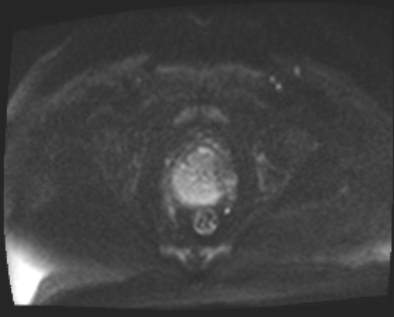 Cancer cervix - stage IIb (Radiopaedia 75411-86615 Axial DWI 66).jpg