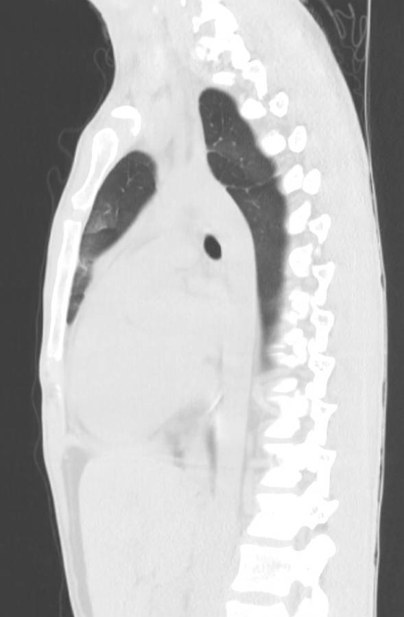 Cannabis-induced diffuse alveolar hemorrhage (Radiopaedia 89834-106946 Sagittal lung window 76).jpg