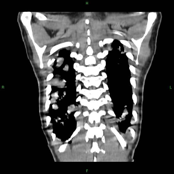 File:Cannon ball metastases - synovial sarcoma (Radiopaedia 26135-26271 Coronal liver window 20).jpg
