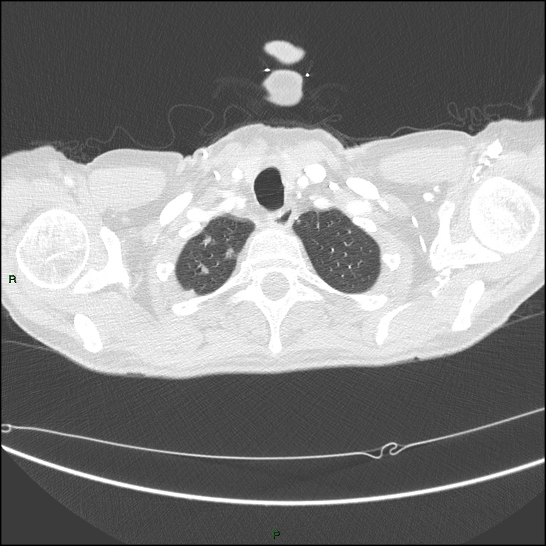 Cannonball metastases (Radiopaedia 82110-96150 Axial lung window 26).jpg