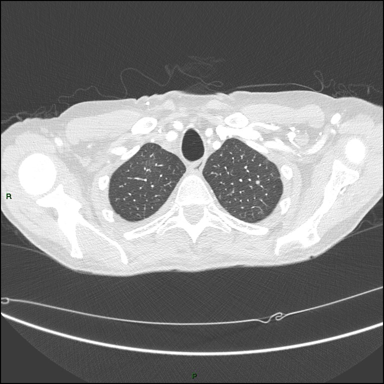 Cannonball metastases (Radiopaedia 82110-96150 Axial lung window 36).jpg