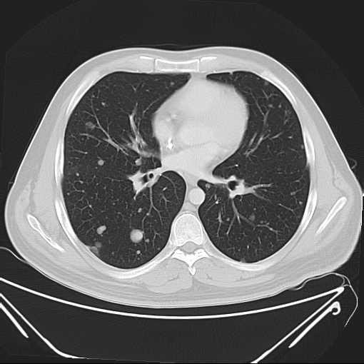 File:Cannonball pulmonary metastases (Radiopaedia 67684-77101 Axial lung window 14).jpg
