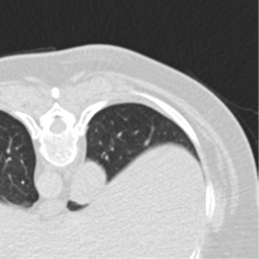 File:Carcinoid tumor - lung (Radiopaedia 44814-48644 Axial lung window 20).png