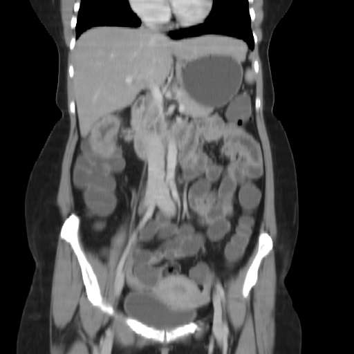 File:Carcinoma colon - hepatic flexure (Radiopaedia 19461-19493 B 18).jpg