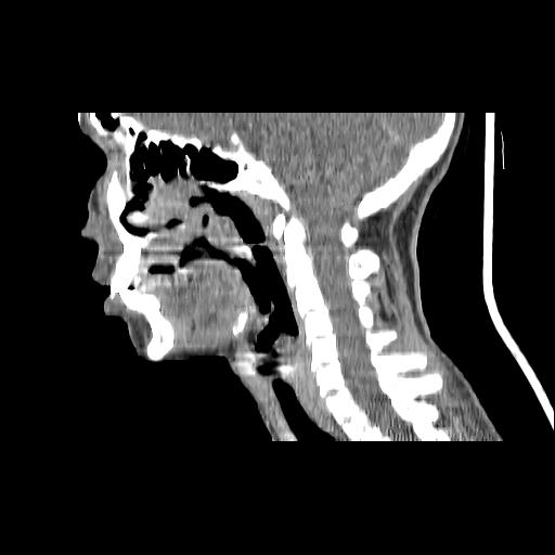 Carcinoma of the maxillary antrum (Radiopaedia 53805-59888 Sagittal C+ delayed 89).jpg