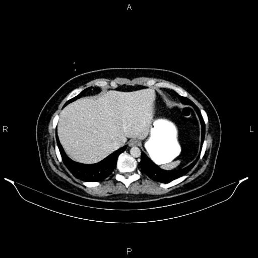 Carcinoma of uterine cervix (Radiopaedia 85861-101700 A 30).jpg