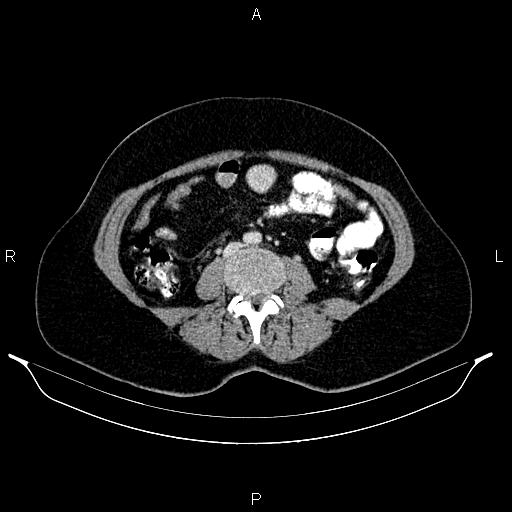 File:Carcinoma of uterine cervix (Radiopaedia 85861-101700 A 53).jpg