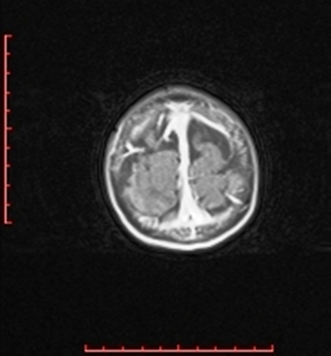 Cardiac rhabdomyoma - tuberous sclerosis (Radiopaedia 70089-80114 Axial T1 C+ fat sat 103).jpg