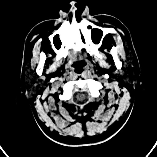 Cardioembolic stroke- ACA and MCA territories (Radiopaedia 58904-66140 Axial non-contrast 26).jpg