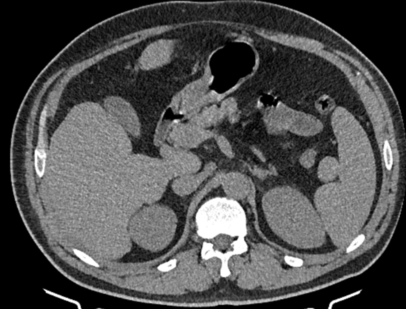 Cardiogenic pulmonary edema (Radiopaedia 68180-77678 Axial non-contrast 67).jpg