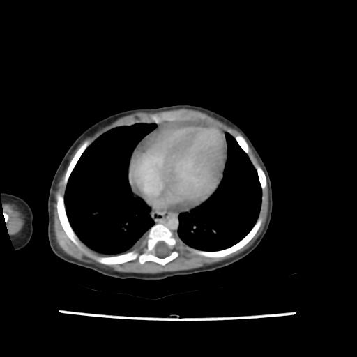 Caroli disease with autosomal recessive polycystic kidney disease (ARPKD) (Radiopaedia 89651-106703 B 4).jpg