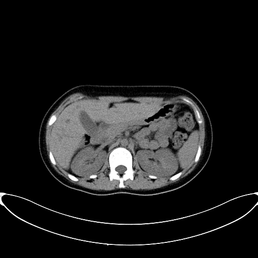 File:Caroli disease with medullary sponge kidney (Radiopaedia 82622-96804 Axial non-contrast 25).jpg