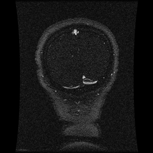 Carotid arterial dissection with acute cerebral infarction (Radiopaedia 26636-26784 MRV 44).jpg